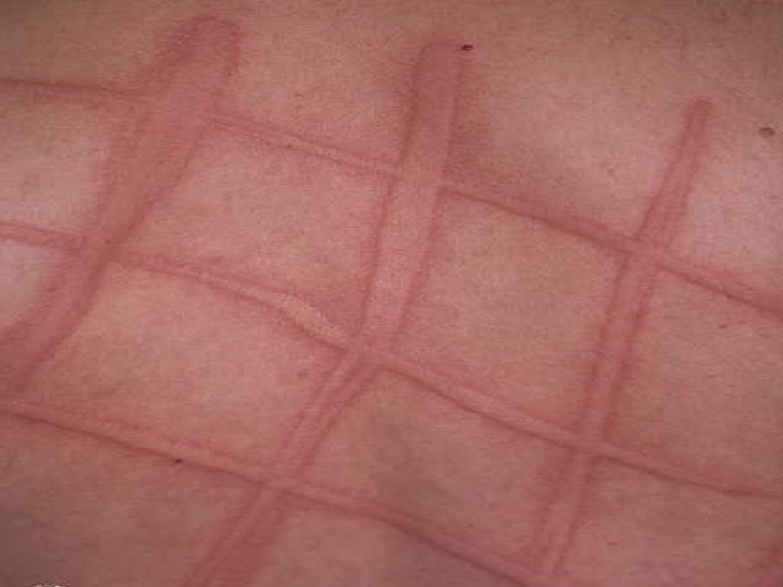 sitesearch: exact match: © 2002 by Derm. IS - Dermatology Information System sitesearch: exact match: © 2002 by Derm. IS - Dermatology Information System