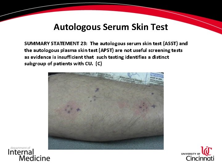 Autologous Serum Skin Test SUMMARY STATEMENT 23: The autologous serum skin test (ASST) and Autologous Serum Skin Test SUMMARY STATEMENT 23: The autologous serum skin test (ASST) and