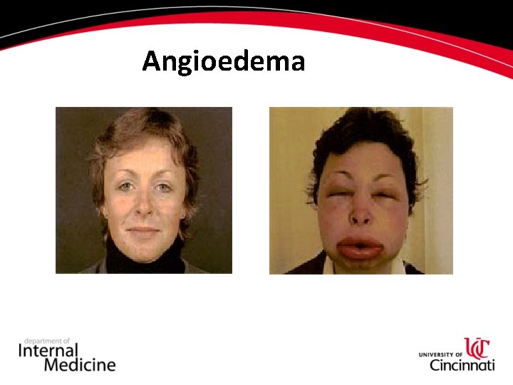 Evaluation of Urticaria and Angiodema An Update Jonathan
