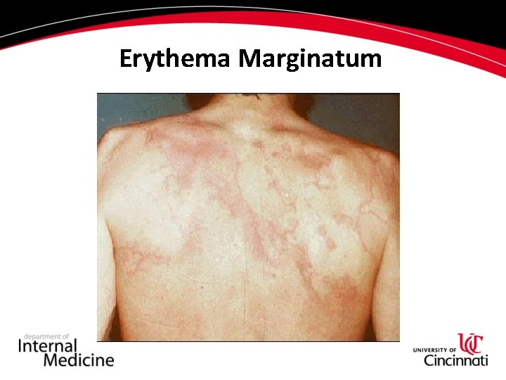 Erythema Marginatum Erythema Marginatum