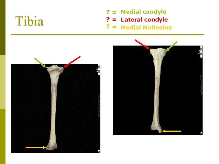 Tibia ? = Medial condyle ? = Lateral condyle ? = Medial Malleolus 