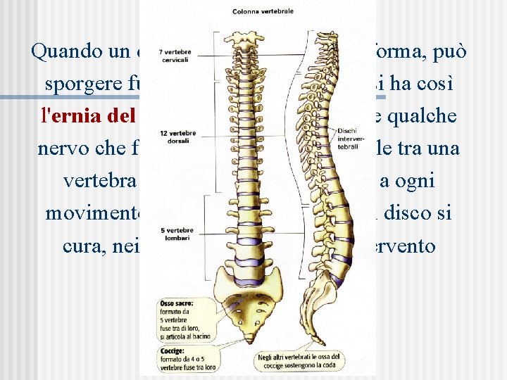 Quando un disco intervertebrale si deforma, può sporgere fuori dal corpo vertebrale; si ha