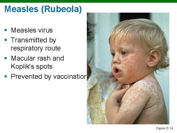 Measles (Rubeola) § Measles virus § Transmitted by respiratory route § Macular rash and