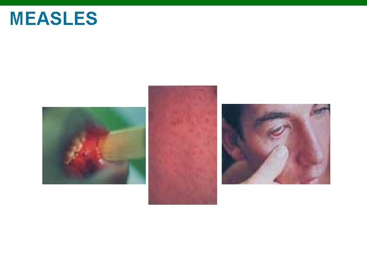 MEASLES Copyright © 2010 Pearson Education, Inc. 