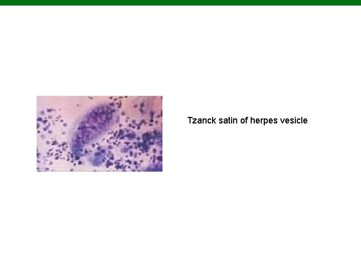 Tzanck satin of herpes vesicle Copyright © 2010 Pearson Education, Inc. 