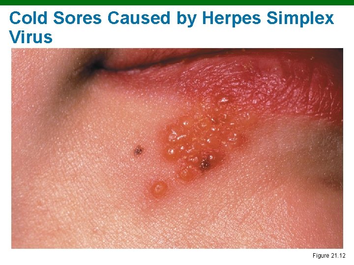 Cold Sores Caused by Herpes Simplex Virus Copyright © 2010 Pearson Education, Inc. Figure