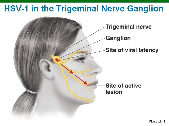 HSV-1 in the Trigeminal Nerve Ganglion Copyright © 2010 Pearson Education, Inc. Figure 21.
