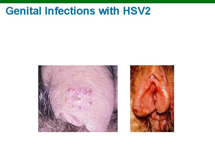 Genital Infections with HSV 2 Copyright © 2010 Pearson Education, Inc. 