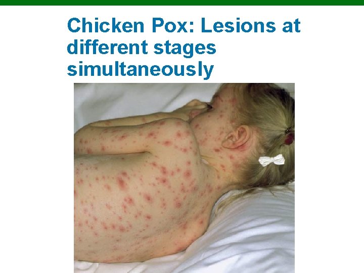 Chicken Pox: Lesions at different stages simultaneously Copyright © 2010 Pearson Education, Inc. 