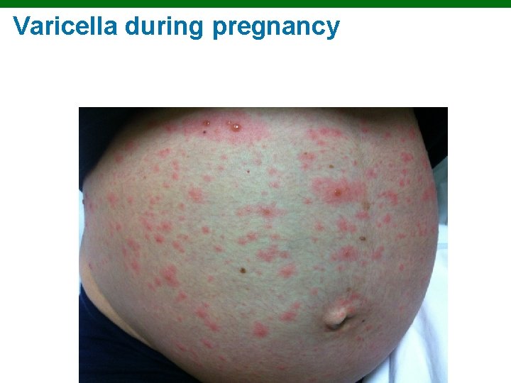 Varicella during pregnancy Copyright © 2010 Pearson Education, Inc. 