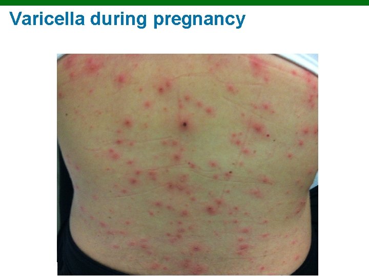 Varicella during pregnancy Copyright © 2010 Pearson Education, Inc. 