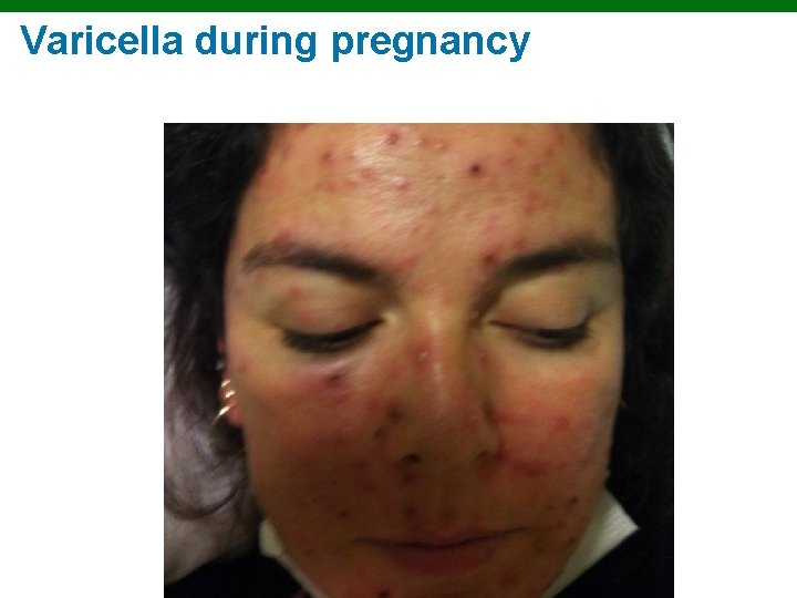 Varicella during pregnancy Copyright © 2010 Pearson Education, Inc. 