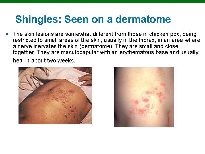 Shingles: Seen on a dermatome § The skin lesions are somewhat different from those