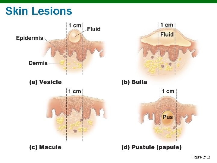 Skin Lesions Copyright © 2010 Pearson Education, Inc. Figure 21. 2 