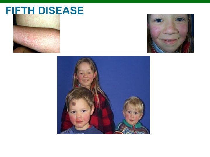 FIFTH DISEASE Copyright © 2010 Pearson Education, Inc. 