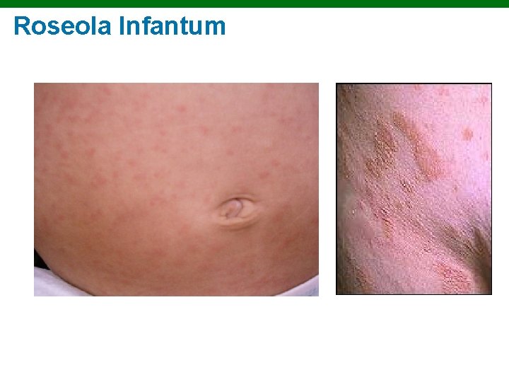 Roseola Infantum Copyright © 2010 Pearson Education, Inc. 