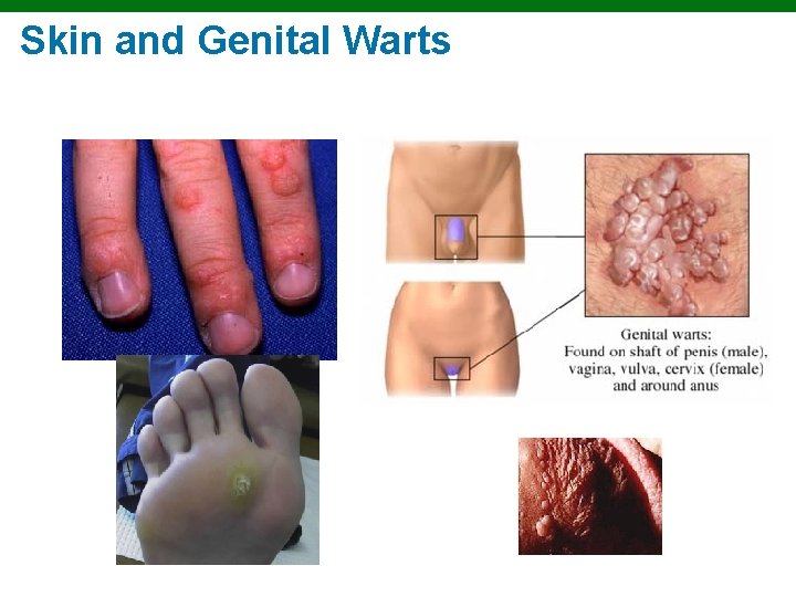 Skin and Genital Warts Copyright © 2010 Pearson Education, Inc. 