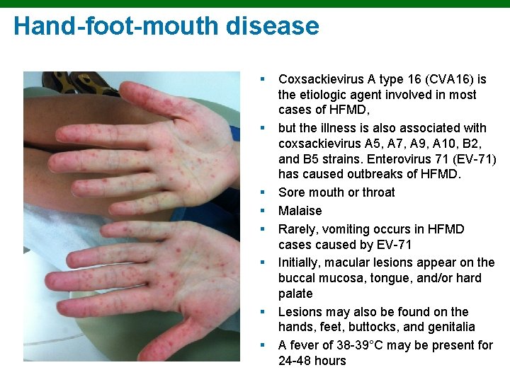 Hand-foot-mouth disease § § § § Copyright © 2010 Pearson Education, Inc. Coxsackievirus A