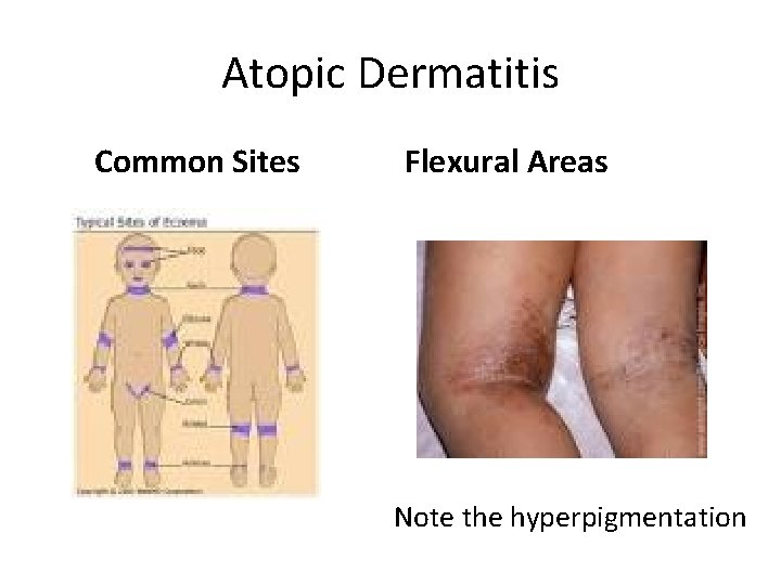Atopic Dermatitis Common Sites Flexural Areas Note the hyperpigmentation 