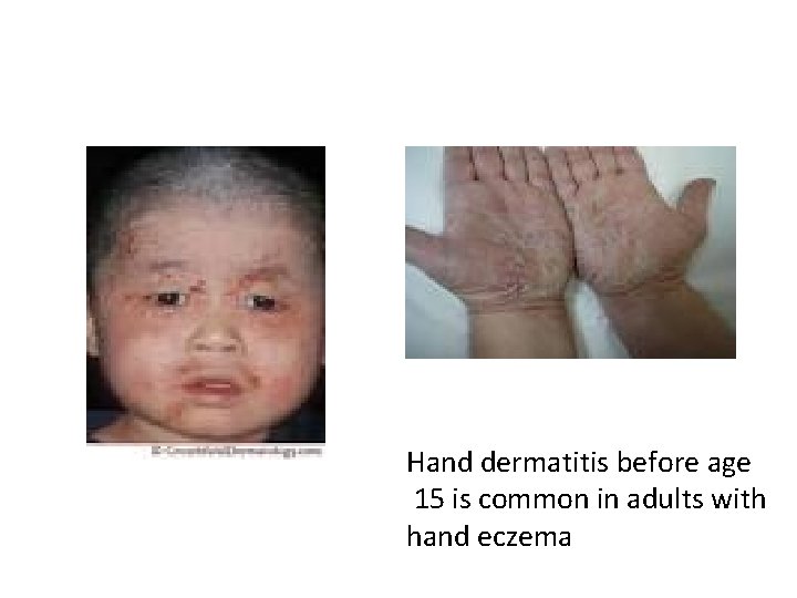 Hand dermatitis before age 15 is common in adults with hand eczema 