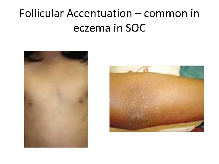 Follicular Accentuation – common in eczema in SOC 
