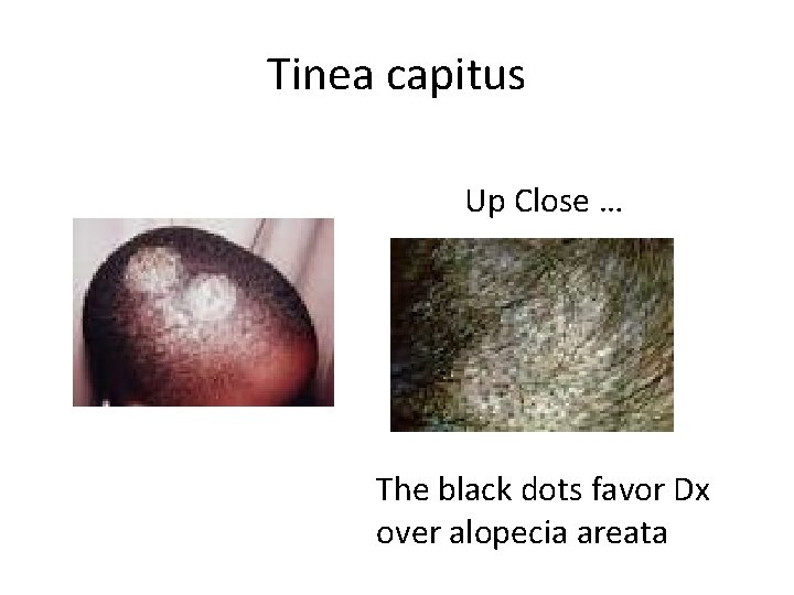 Tinea capitus Up Close … The black dots favor Dx over alopecia areata 