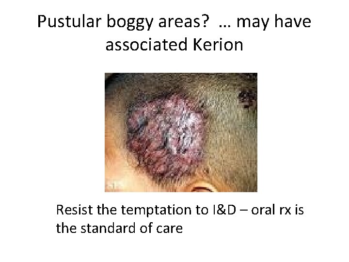 Pustular boggy areas? … may have associated Kerion Resist the temptation to I&D –