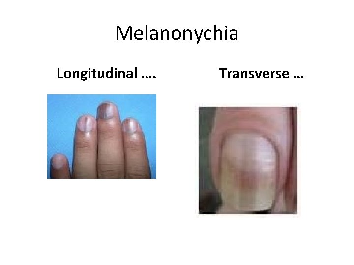 Melanonychia Longitudinal …. Transverse … 
