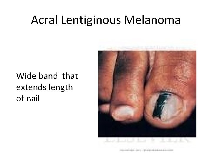 Acral Lentiginous Melanoma Wide band that extends length of nail 