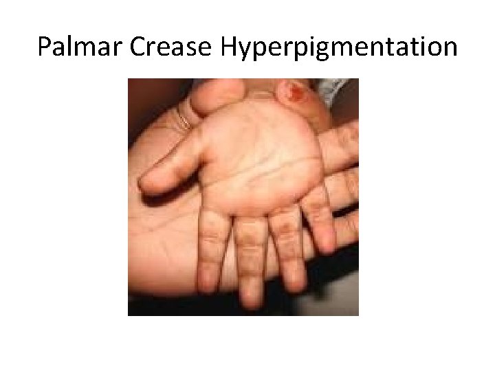 Palmar Crease Hyperpigmentation 