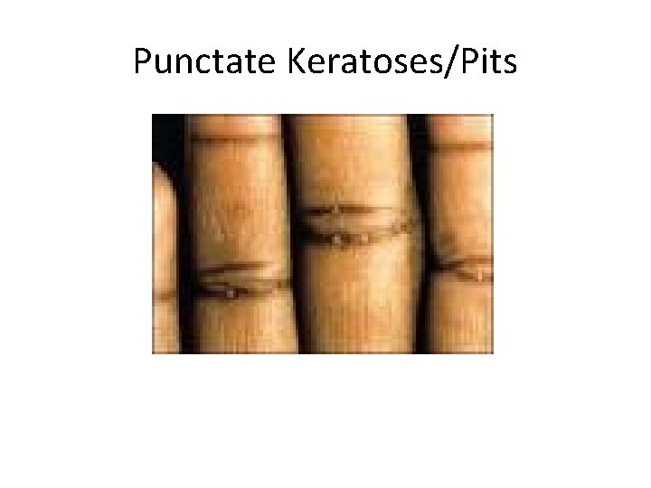 Punctate Keratoses/Pits 