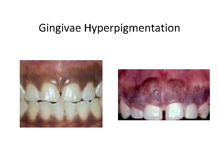 Gingivae Hyperpigmentation 