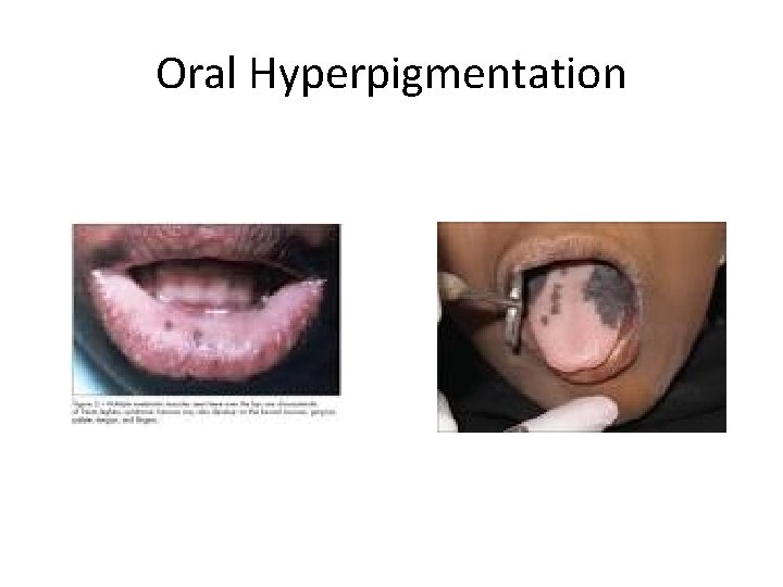 Oral Hyperpigmentation 