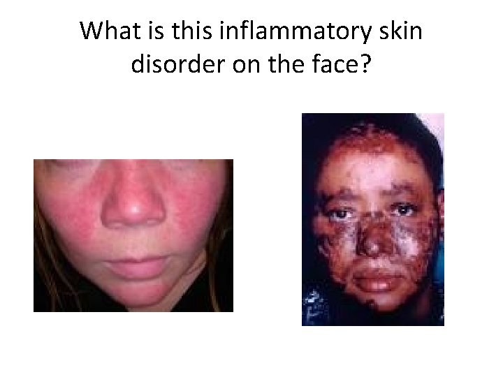 What is this inflammatory skin disorder on the face? 