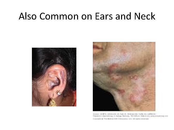 Also Common on Ears and Neck 