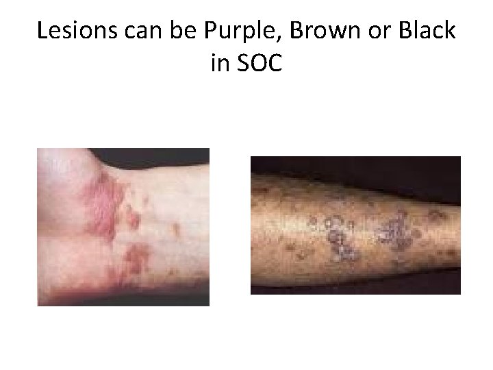 Lesions can be Purple, Brown or Black in SOC 