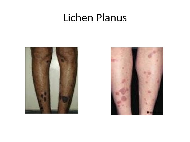 Lichen Planus 