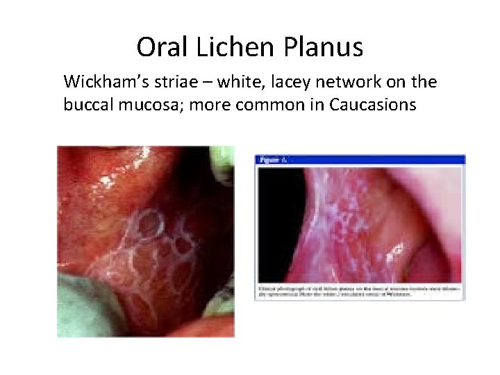 Oral Lichen Planus Wickham’s striae – white, lacey network on the buccal mucosa; more