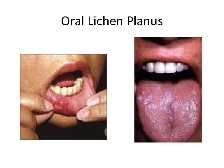 Oral Lichen Planus 