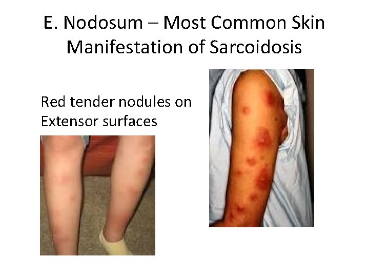 E. Nodosum – Most Common Skin Manifestation of Sarcoidosis Red tender nodules on Extensor