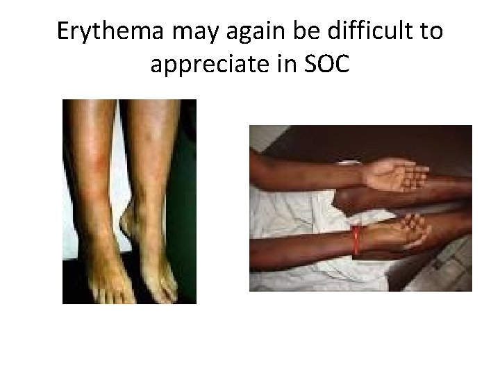 Erythema may again be difficult to appreciate in SOC 