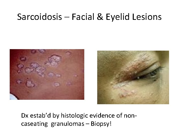 Sarcoidosis – Facial & Eyelid Lesions Dx estab’d by histologic evidence of noncaseating granulomas