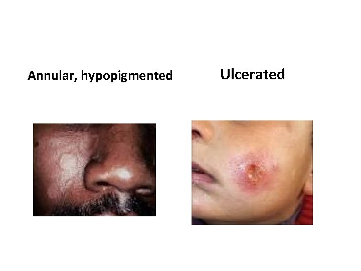 Annular, hypopigmented Ulcerated 