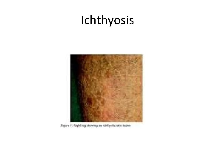 Ichthyosis 