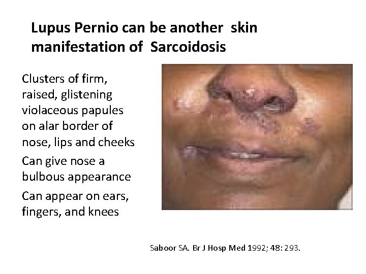 Lupus Pernio can be another skin manifestation of Sarcoidosis Clusters of firm, raised, glistening