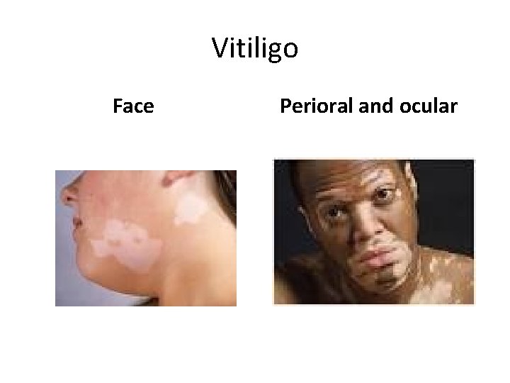 Vitiligo Face Perioral and ocular 