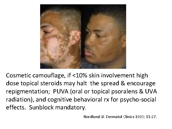 Cosmetic camouflage, if <10% skin involvement high dose topical steroids may halt the spread