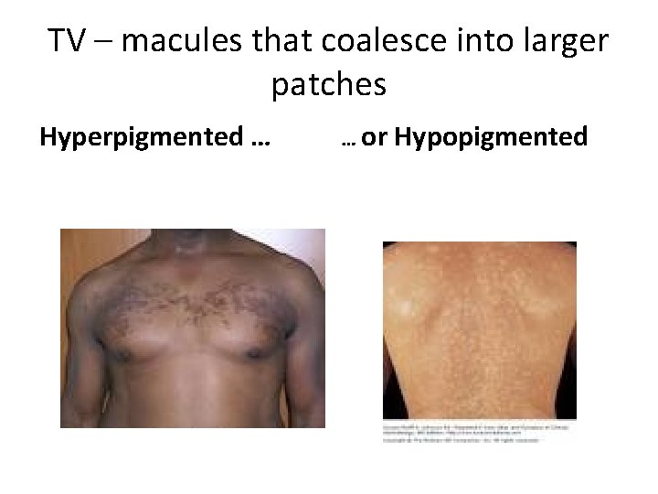 TV – macules that coalesce into larger patches Hyperpigmented … … or Hypopigmented 