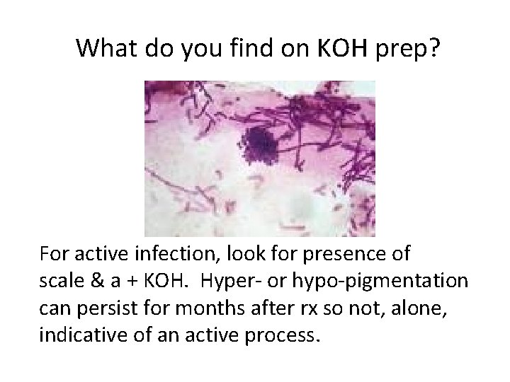 What do you find on KOH prep? For active infection, look for presence of