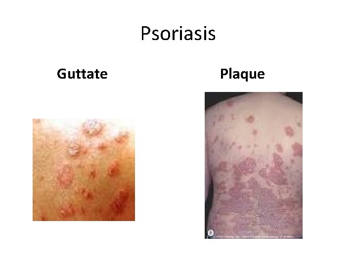 Psoriasis Guttate Plaque 